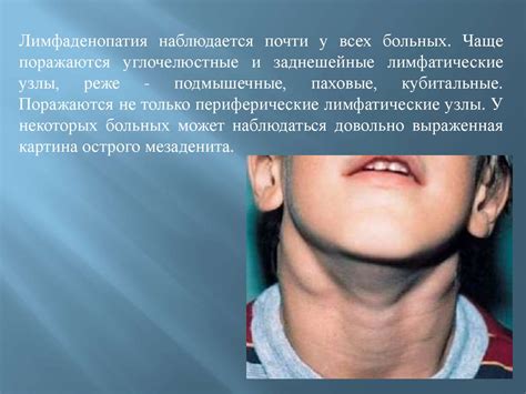 Инфекционный мононуклеоз - презентация онлайн