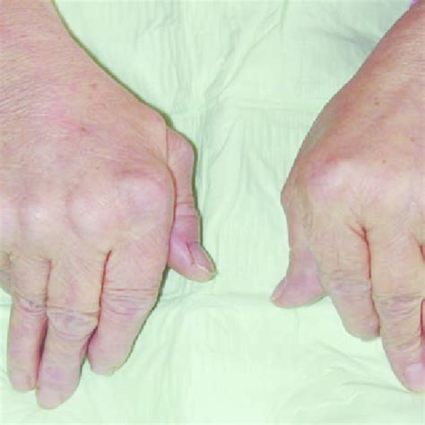 ulnar deviation   digits   hand  thumbs show