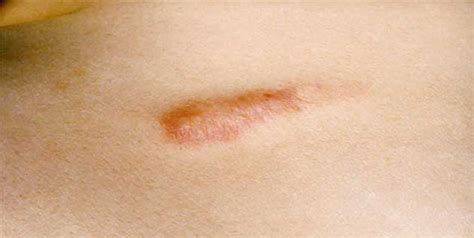 About Keloid - symptoms, causes and keloid treatment | OnlyMyHealth