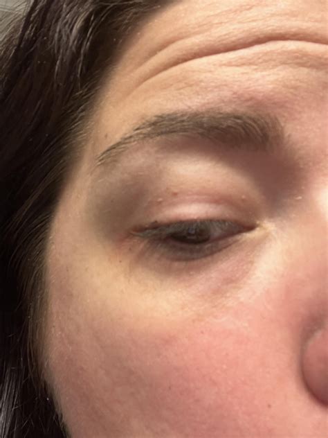 Doesn’t look quite like milia, maybe skin tags? On one eyelid. : r