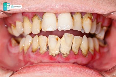 cach chua viem nuou chan rang  toan tai nha doctor  san