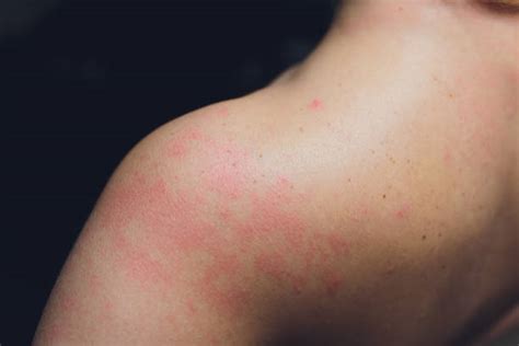 man skin rash stock  pictures royalty  images istock