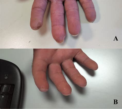 Ischemic hand ulcers before (A) and after (B) treatment | Download ...