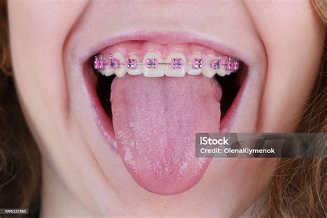 Dentes Para Fora Da Boca - Foto de Mulher Com Abrir A Boca E Aparelho Nos Dentes Retos Mostrando A ...
