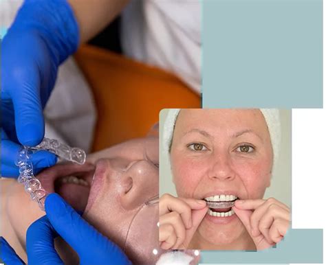 Nightguards – WNC Dental | Asheville, NC