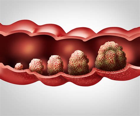 colon polyps    concern gastrohealth clinic