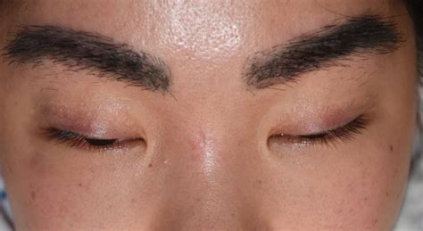Plastic Surgery Case Study - Medial Epicanthoplasty Skin Flap ...