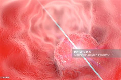 Oesophageal Cancer Treatment Illustration High-Res Vector Graphic ...