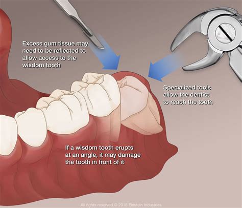 Wisdom Teeth Removal Warsaw, IN - Dental Solutions