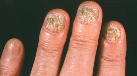 Fingernail Diseases