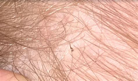 WHAT DO LICE LOOK LIKE UP CLOSE | LiceDoctors