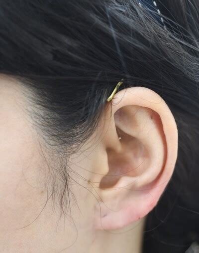 [20代 女性] 耳タブをヒアルロン酸で大きくする（耳の整形）の症例写真 (CS73165)｜みずほクリニック《美容医療の口コミ広場》