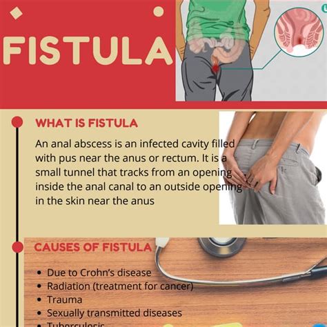 Fistula - Causes, Symptoms and Herbal Treatment | PDF