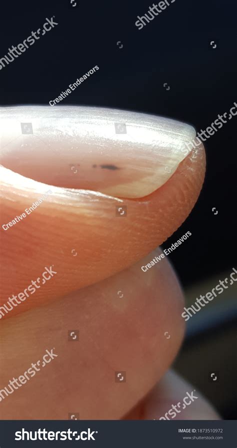 55 Splinter Hemorrhages Images, Stock Photos & Vectors | Shutterstock