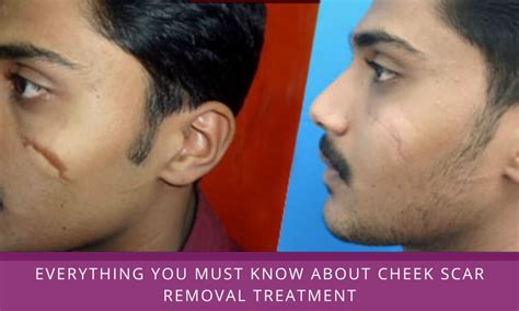 Erase the Past: Effective Scar Removal Techniques for Your Face - Hunter Games Magazine