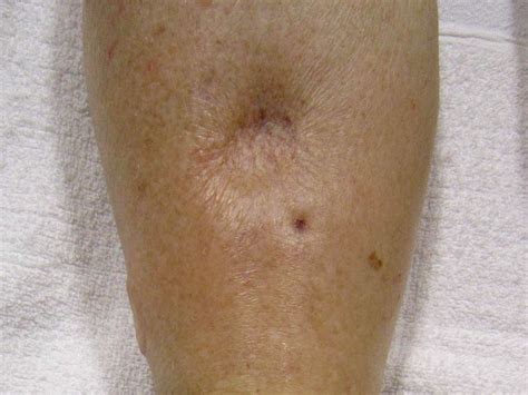 Diabetes Leg Swelling - DiabetesWalls