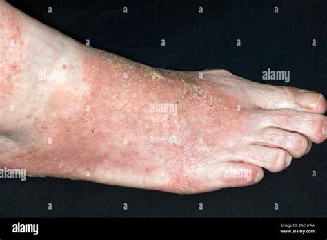 Infected eczema on the foot in a 70 year old alcoholic female patient ...