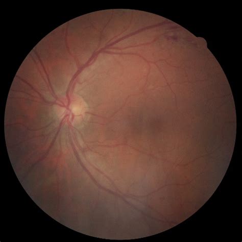 detectophtdiseases object detection dataset  marmara university