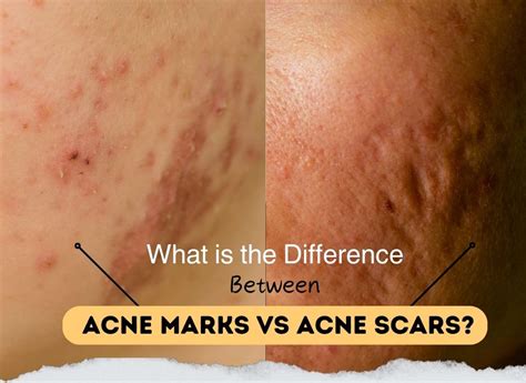 difference  acne marks  acne scars