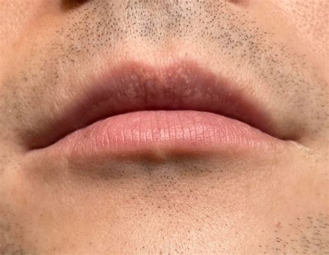 Fordyce Granules Lip