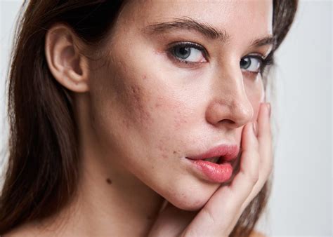 Acne - Daleswood Aesthetics Solihull