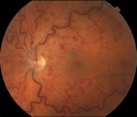 Retinal Vein Occlusion Treatment - Best Retinal Specialists in New York