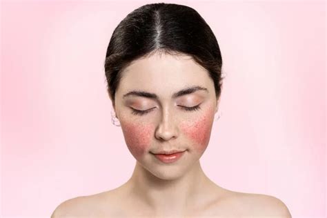 rosacea  complete guide  symptoms    treatments