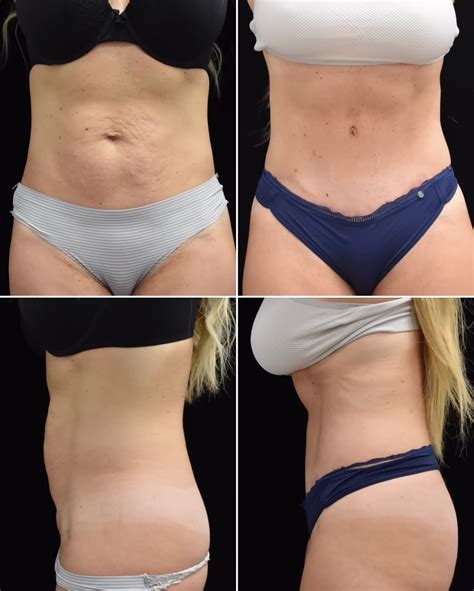 ‘RHONJ’ Star Danielle Cabral Reveals Tummy Tuck Results | Us Weekly