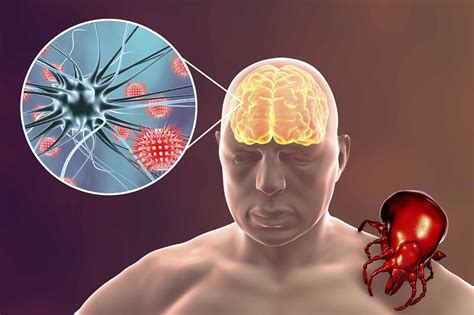 Клещевой энцефалит: симптомы, причины, инкубационный период, чем опасен ...