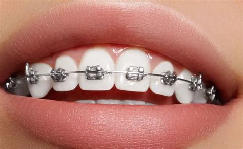 gentle braces gentle dental wellingtons dentist