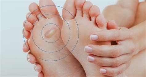 Bolhas No Pe O Que Pode Ser - SOSFisio - o blog da saúde: Bolhas nos pés: veja como evitar e tratar ...