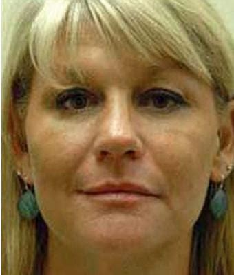 Patient #1391 Fat Transfer Face Before and After Photos Santa Ana ...