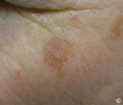 Actinic keratosis, solar keratosis