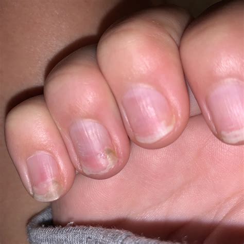 Fingernail Fungus From Acrylic Nails