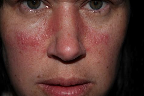 rash on face only - pictures, photos