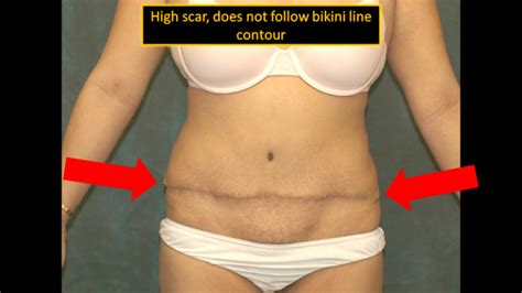 tummy tuck dallas southlake plano ft worth tx