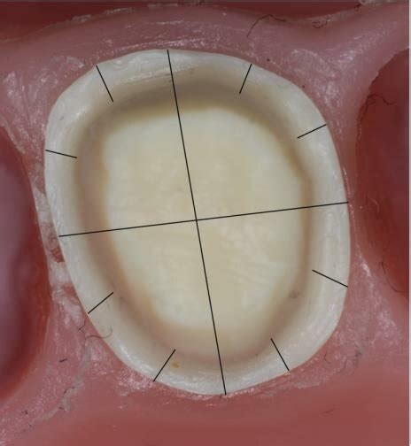 prepared teeth ul  ul   unit  zirconia bridges