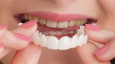 Snap On Smile - Removable Veneers - Tadawi Medical Center