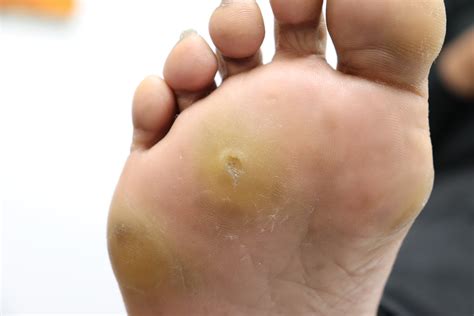 whats  corn  foot flash sales emergencydentistrycom
