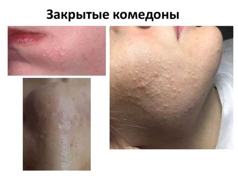 Виды акне - Косметолог, косметологические услуги в Великом Новгороде ...