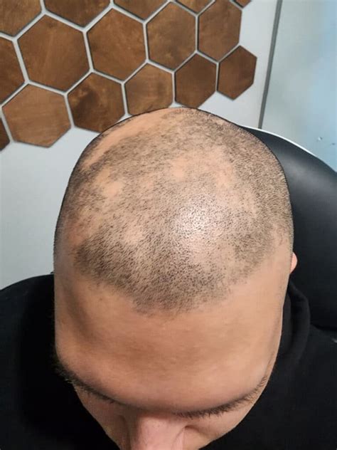 PRP Hair Restoration Archives - The Remedy IV Health and Wellness
