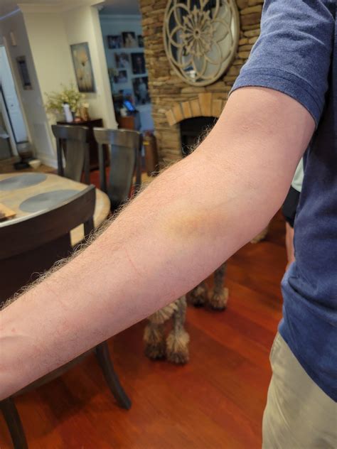 Was playing golf with my dad when on hold 9 he said his arm hurt after