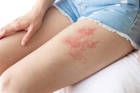 virus   tubuh cacar api bisa dicegah  hidup sehat