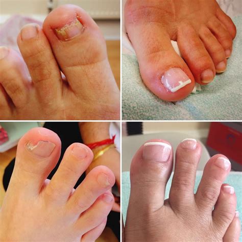 Repairing Nail Bed Damage at James Jain blog