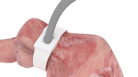3D Stomach With Stomach Band Model - TurboSquid 2282307