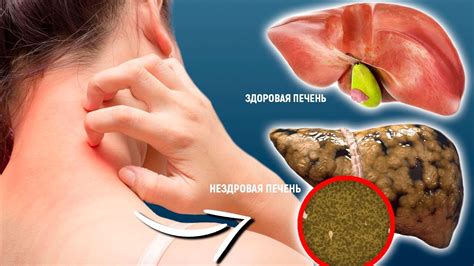 15 Тревожных Сигналов о Том, Что в Печени Полно Токсинов и Шлаков ...