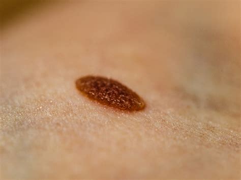 closeup brown mole  skin stock photo  image  melanoma