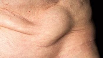 What is Inguinal Hernia? Causes, Surgery, Recovery