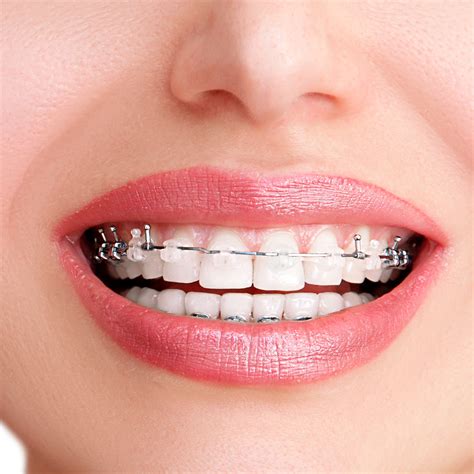 Brackets Autoligado Estéticos en Bogotá – Dr. Jhon Rojas