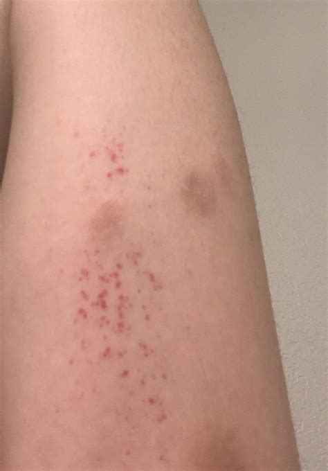 Why Do I Get Red Itchy Spots After Showering at Tammy Jackson blog